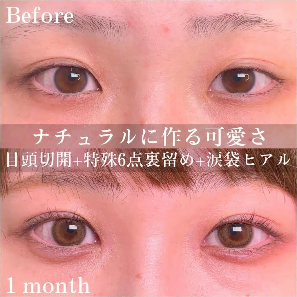 目頭切開 特殊6点裏留め 涙袋ヒアル 東京
