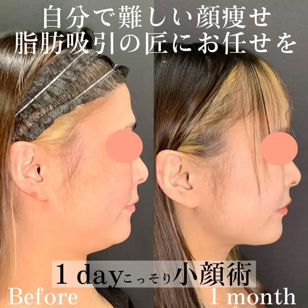 小顔脂肪吸引 東京