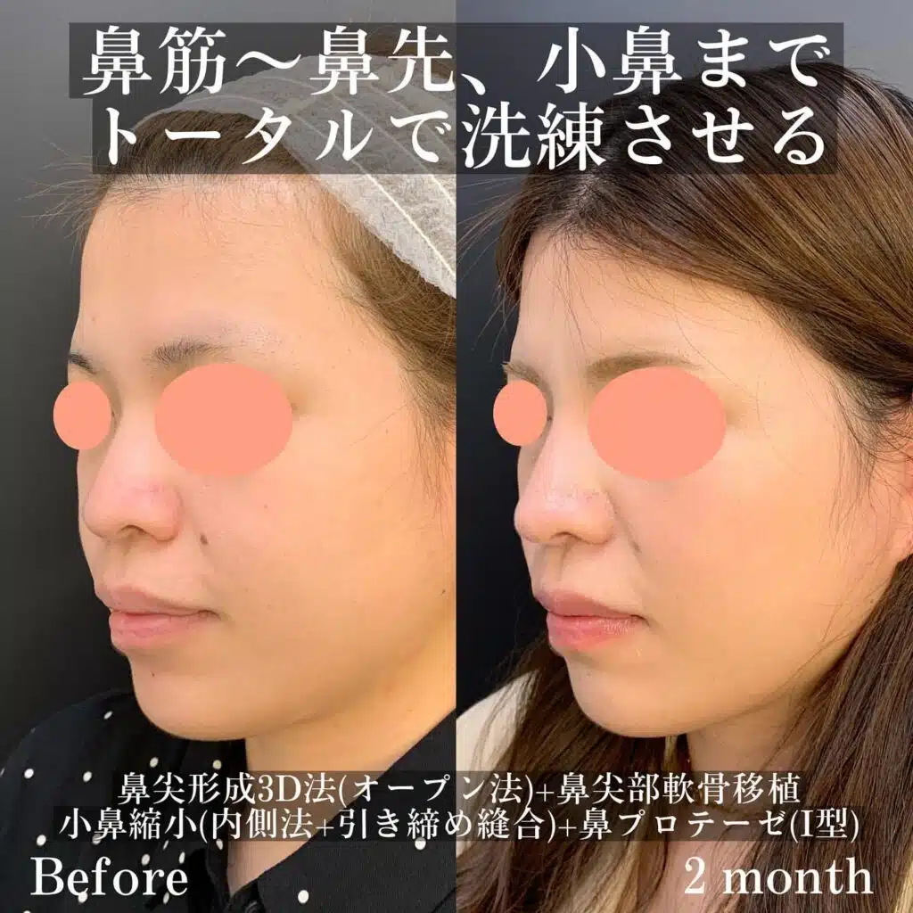 鼻尖形成3D法(オープン法)+鼻尖部軟骨移植+小鼻縮小(内側法+引き締め縫合)+鼻プロテーゼ(Ⅰ型) 東京