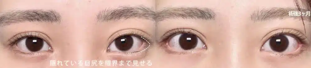 目尻側の白目の露出を増やすデザイン　東京