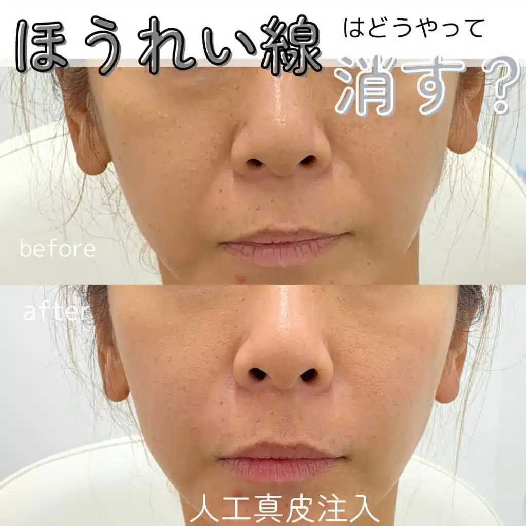 人工真皮注入 東京