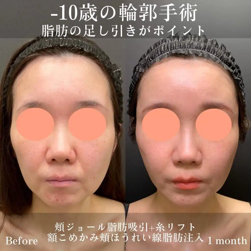 頬ジョール脂肪吸引+糸リフト　額こめかみ頬ほうれい線脂肪注入　東京