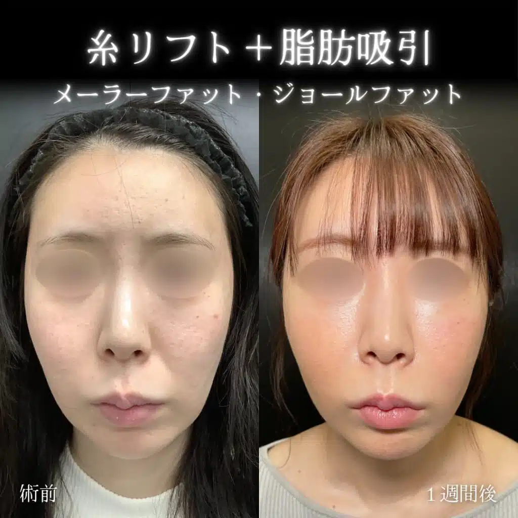 糸リフト＋脂肪吸引　東京