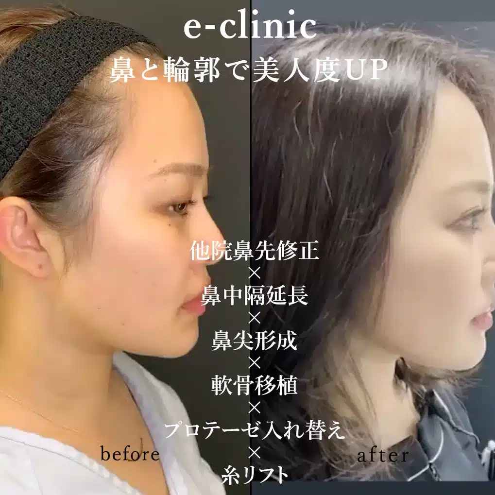 他院鼻先修正×鼻中隔延長×鼻尖形成×軟骨移植×プロテーゼ入れ替え×糸リフト 東京