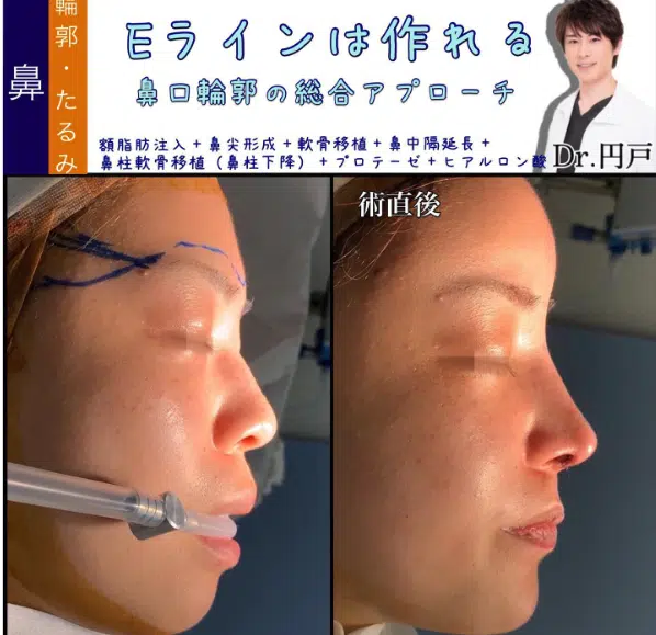 額脂肪注入+鼻尖形成+軟骨移植+鼻中隔延長+鼻柱軟骨移植(鼻柱下降)+プロテーゼ+ヒアルロン酸 東京