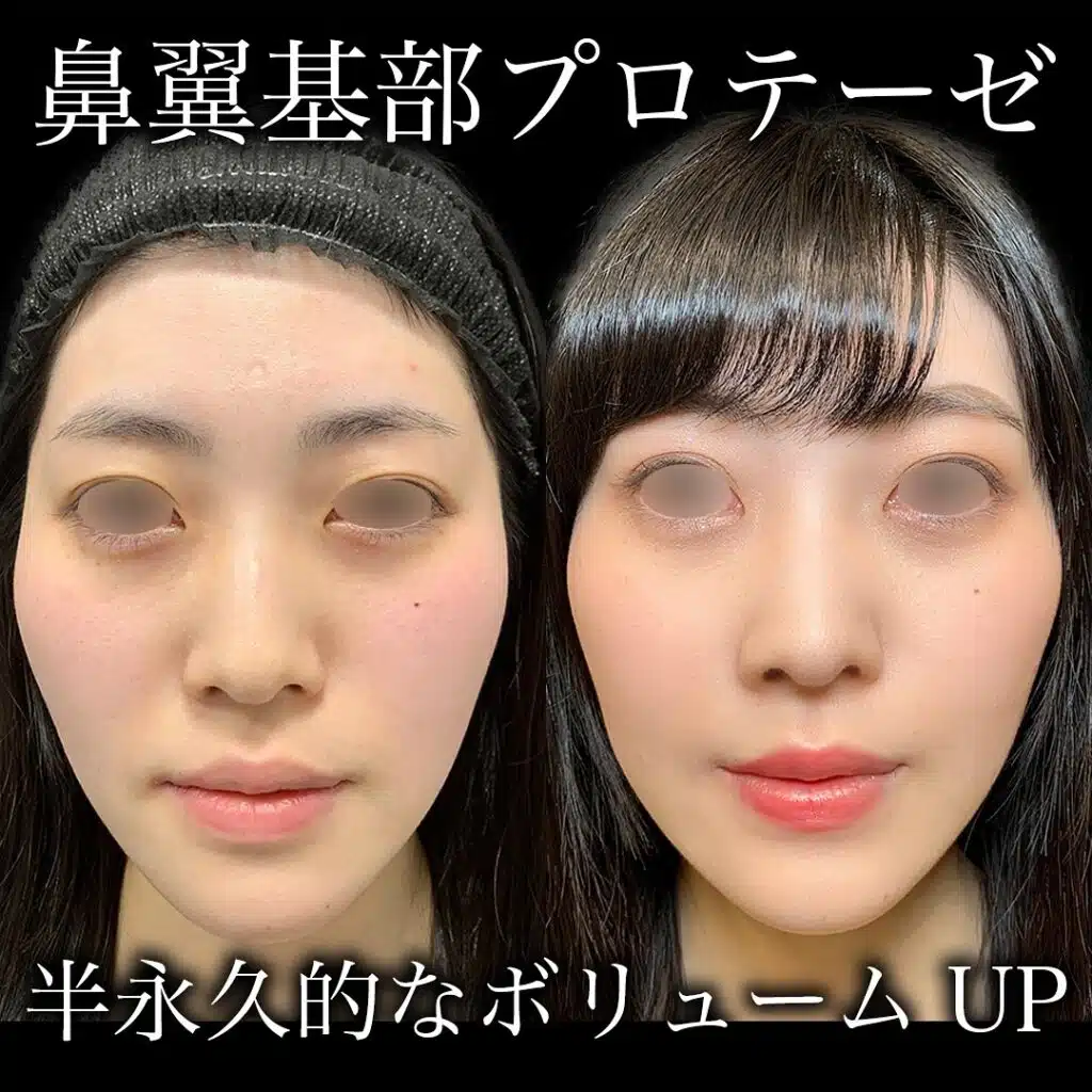 鼻翼基部プロテーゼ 東京