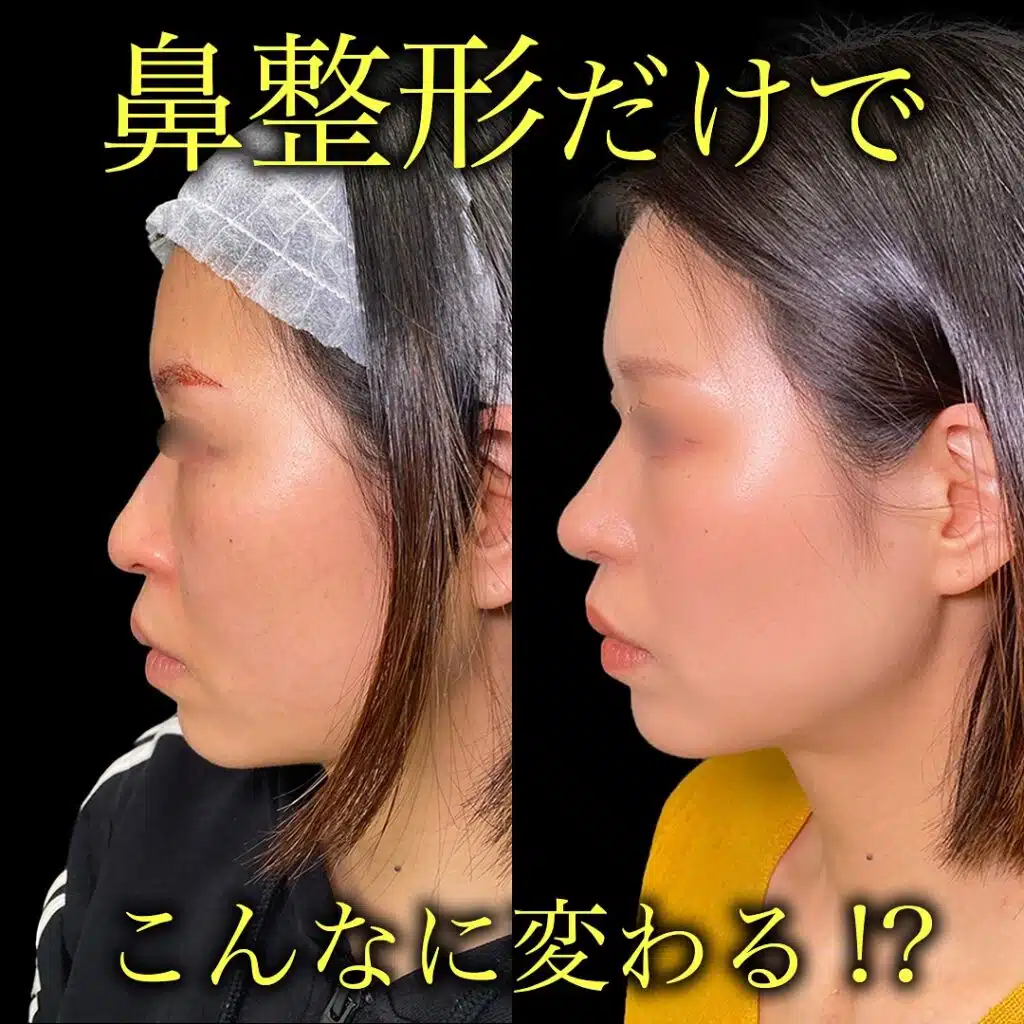 鼻尖形成と耳介軟骨移植と小鼻縮小 東京