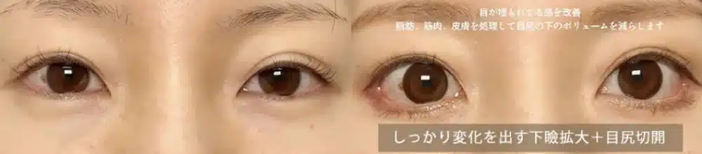 しっかり変化を出す下瞼拡大＋目尻切開　東京