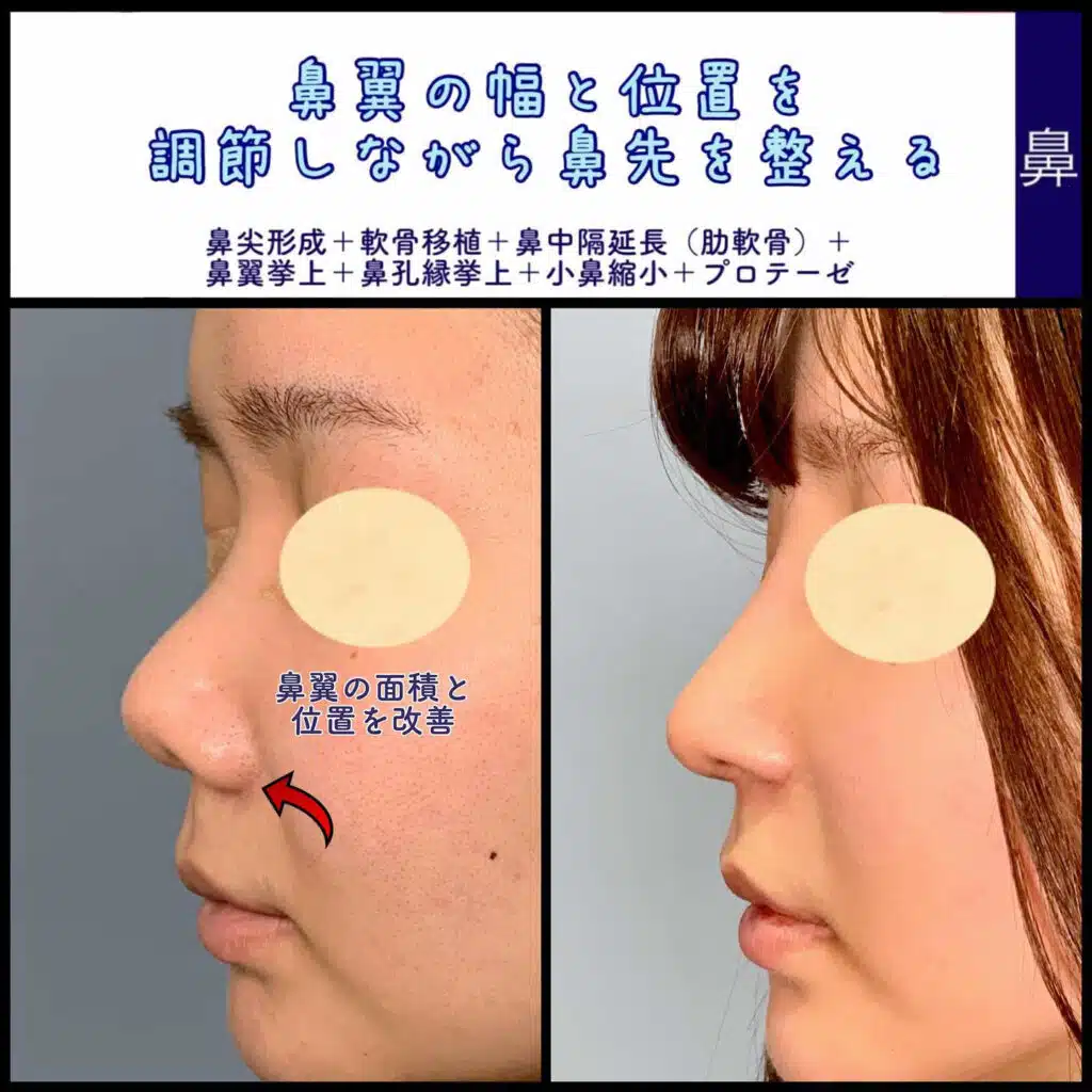 鼻尖形成+軟骨移植+鼻中隔延長(肋軟骨)+鼻翼挙上+鼻孔縁挙上+小鼻縮小+プロテーゼ 東京