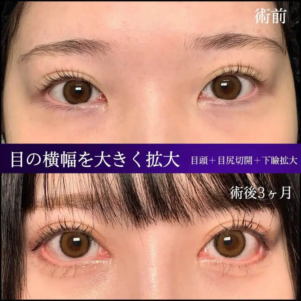 目頭+目尻切開+下瞼拡大 東京