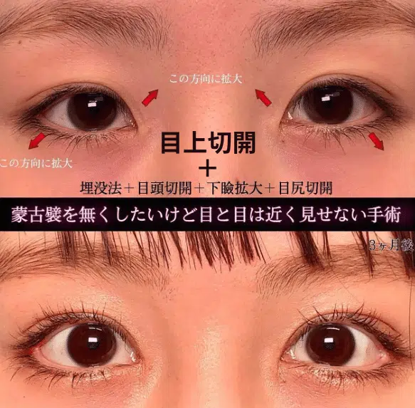 目上切開+埋没法+目頭切開+下瞼拡大+目尻切開 東京