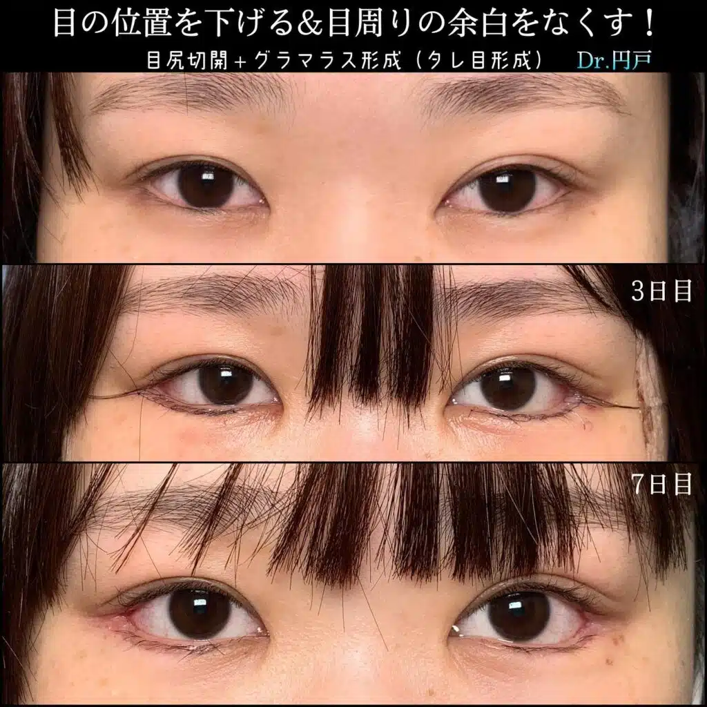 目尻切開+グラマラス形成(タレ目形成) 東京