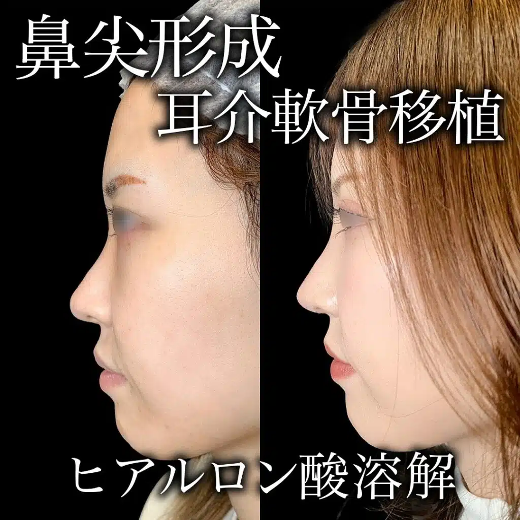 鼻尖形成と耳介軟骨移植 東京