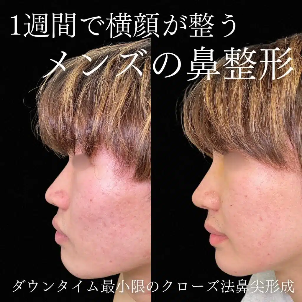 クローズ法鼻尖形成 東京