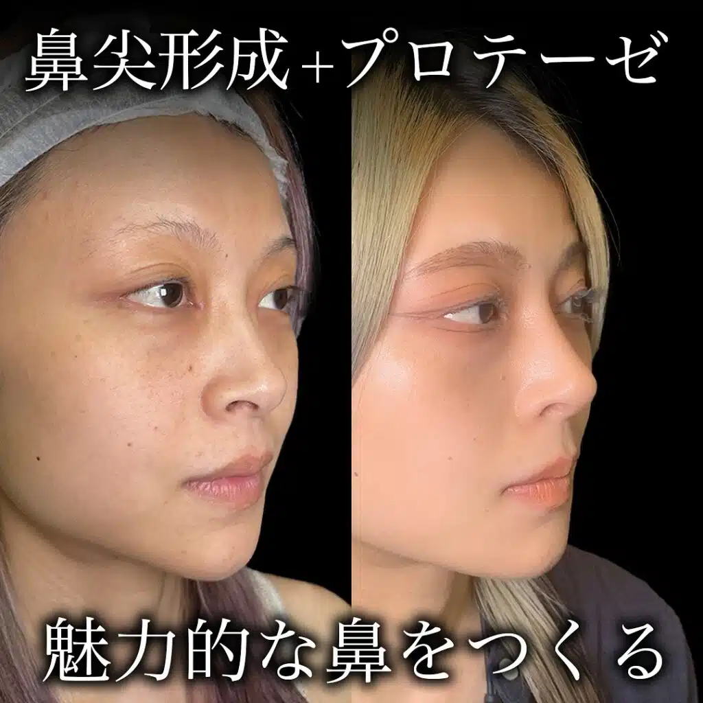 鼻尖形成+プロテーゼ 東京