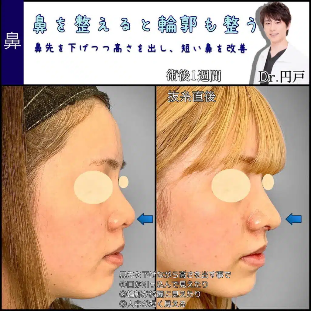 鼻尖形成と鼻中隔延長と軟骨移植 東京