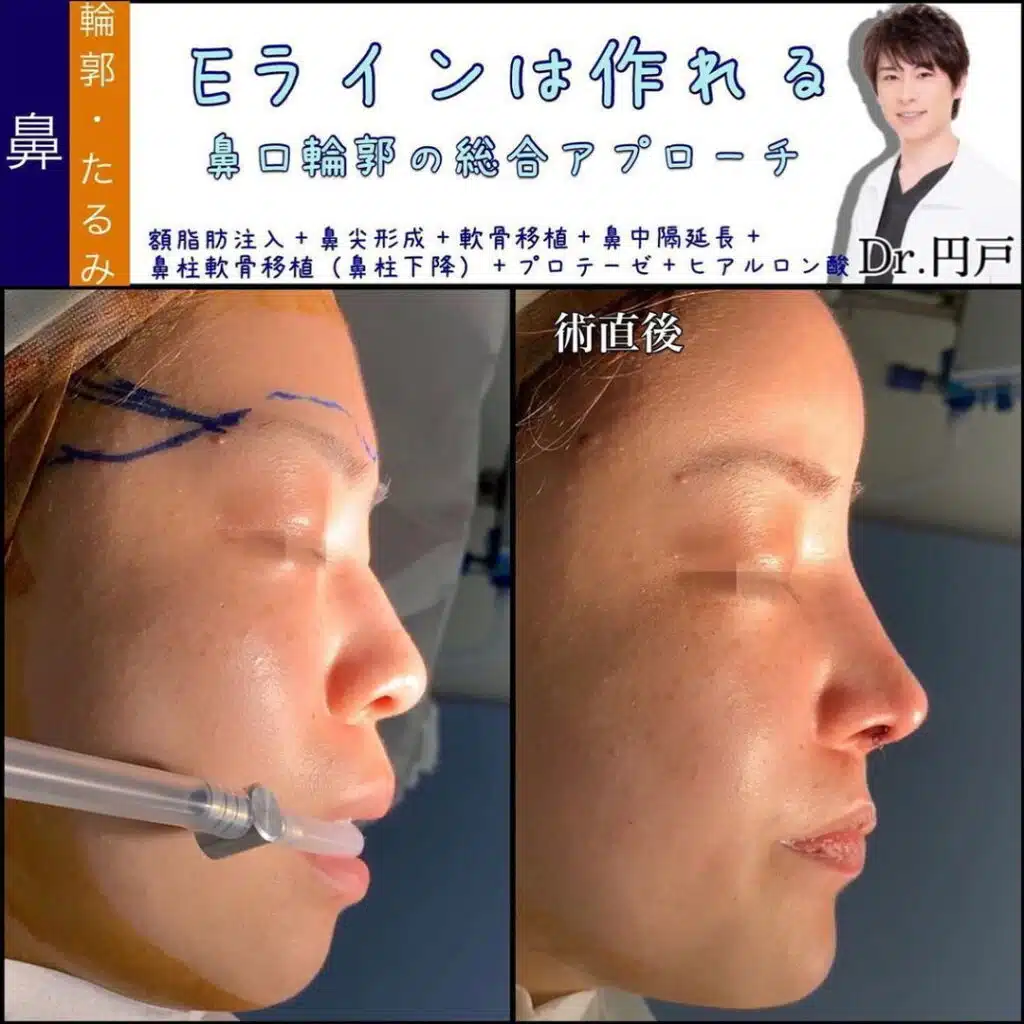 額脂肪注入+鼻尖形成+軟骨移植+鼻中隔延長+鼻柱軟骨移植(鼻柱下降)+プロテーゼ+ヒアルロン酸 東京
