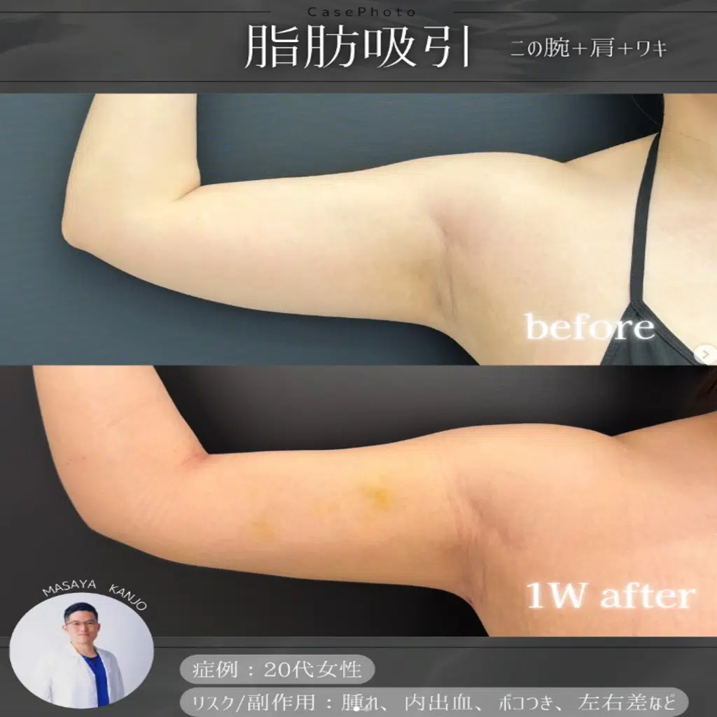 脂肪吸引　二の腕+肩+ワキ　東京