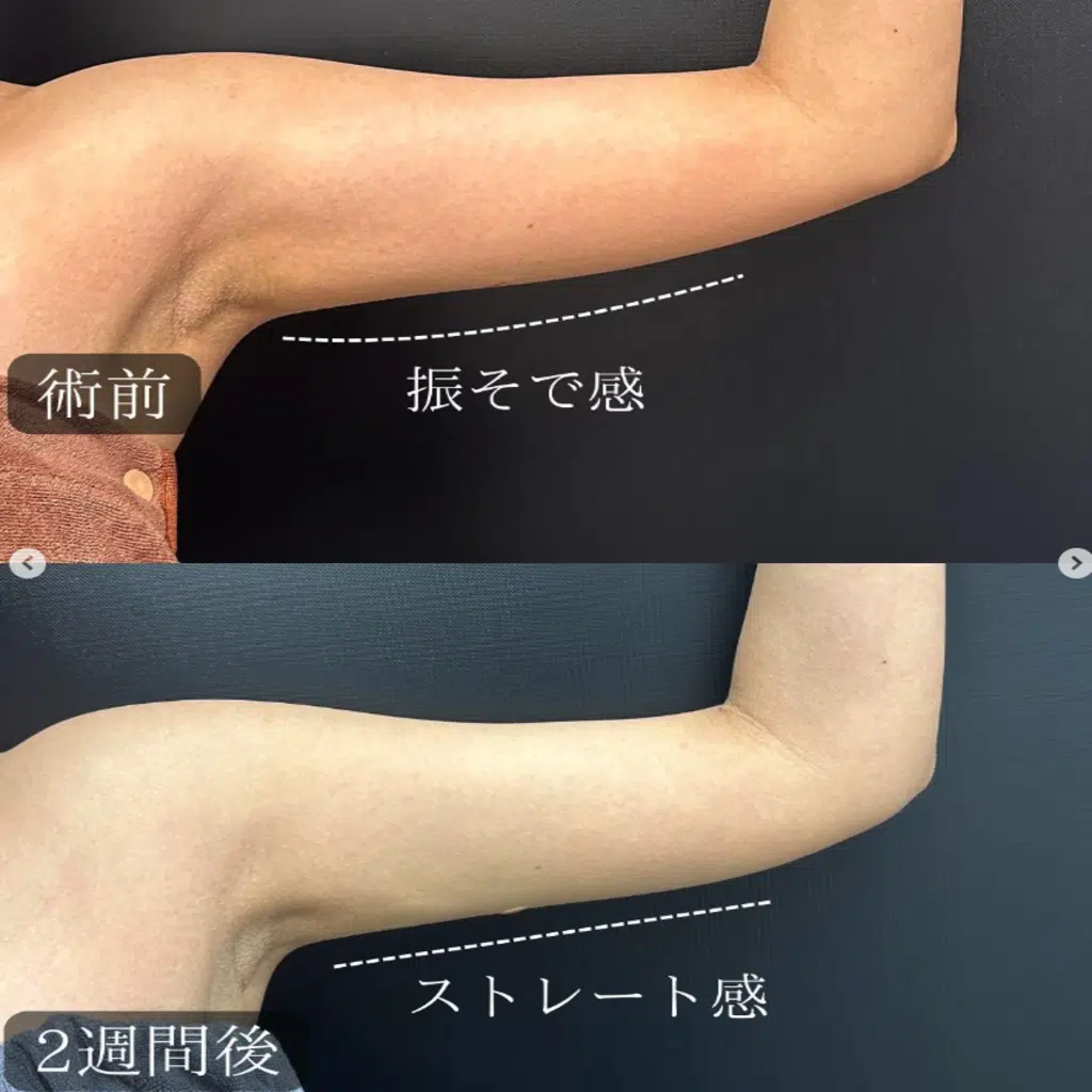 二の腕の脂肪吸引　東京