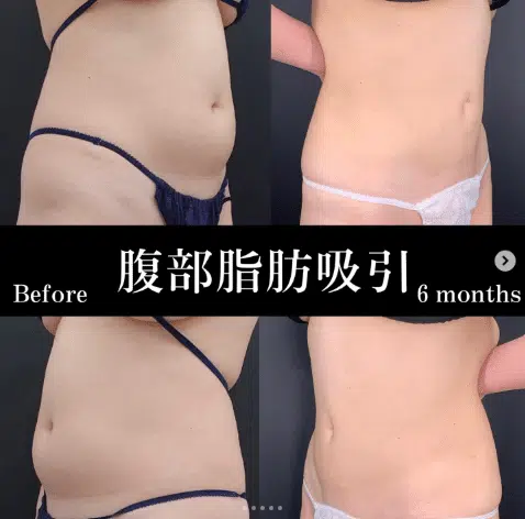 腹部脂肪吸引 東京