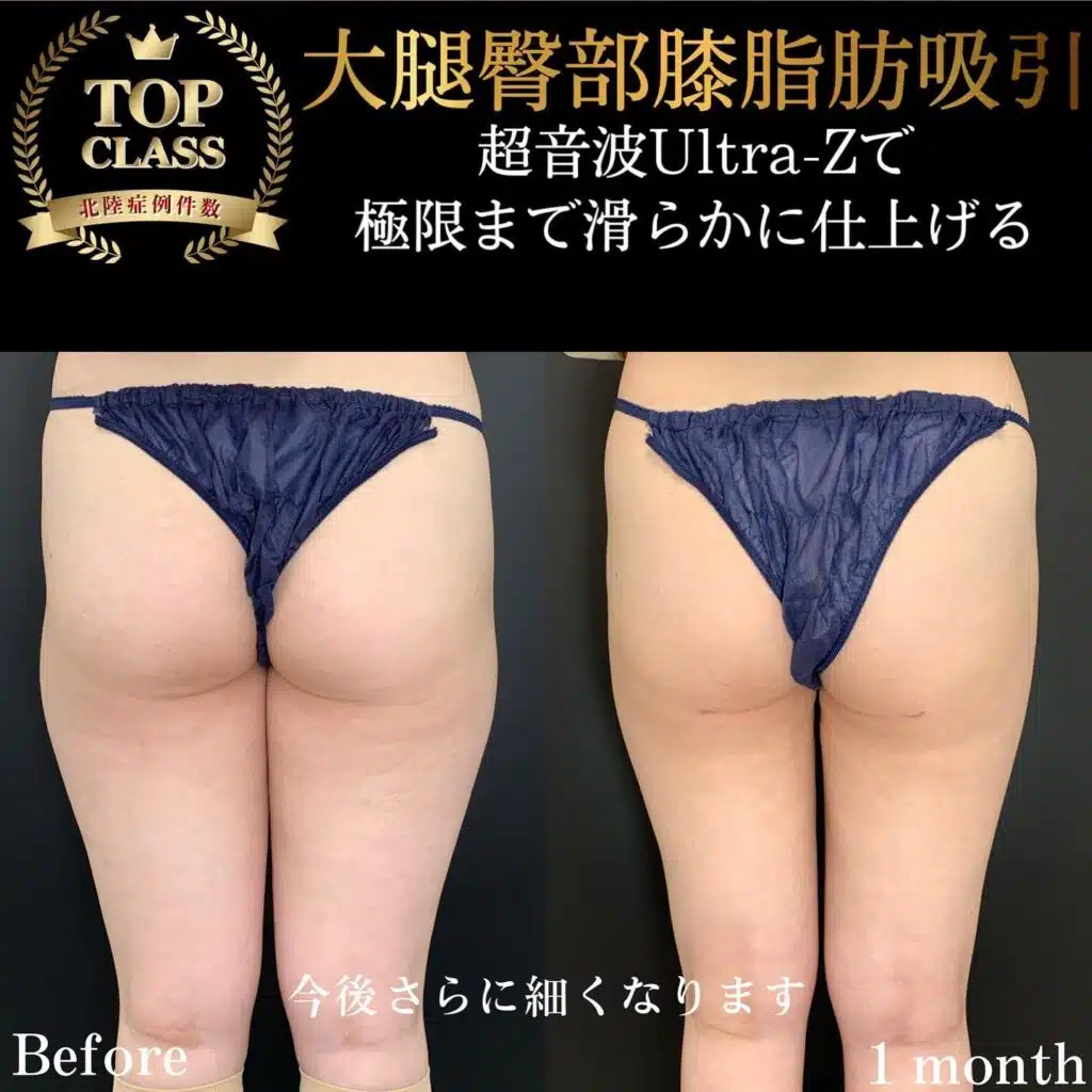大腿臀部膝脂肪吸引　東京