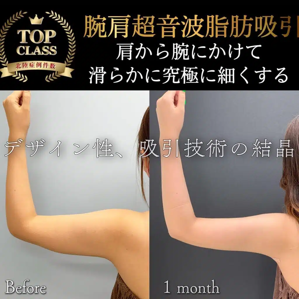 腕肩超音波脂肪吸引　東京