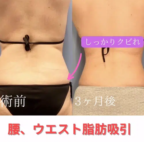 腰、ウエスト脂肪吸引　東京