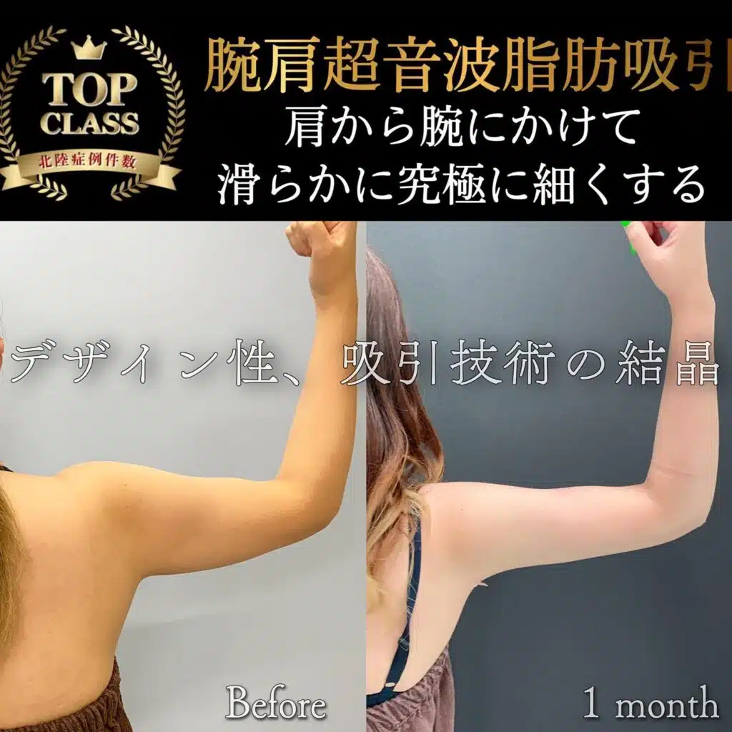 腕肩超音波脂肪吸引　東京