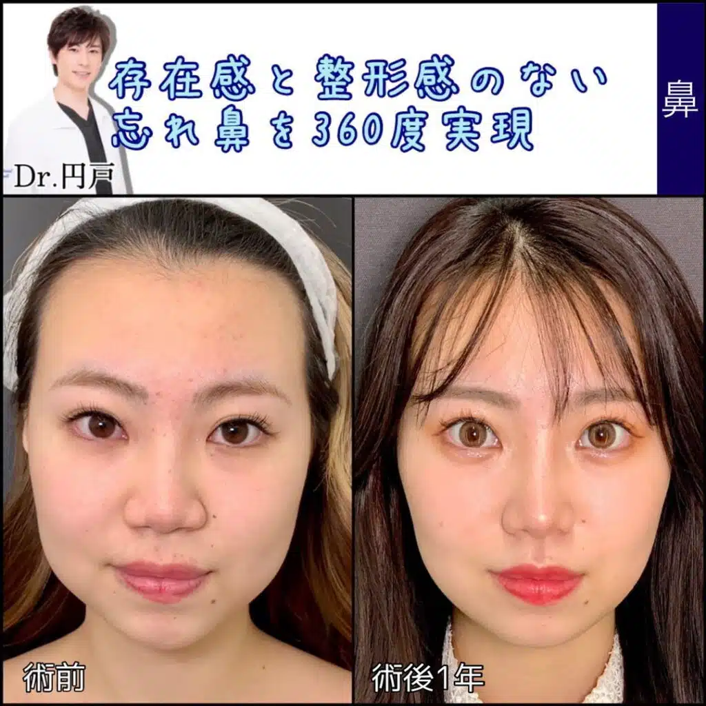 鼻尖形成+軟骨移植+鼻中隔延長、法令線基部人口真皮、鼻背部軟骨以上、小鼻縮小 (2) 東京
