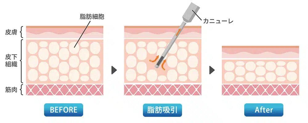 脂肪吸引　図解　東京