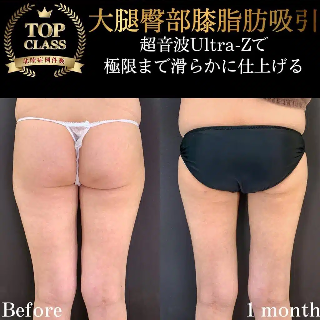 大腿臀部膝脂肪吸引　東京