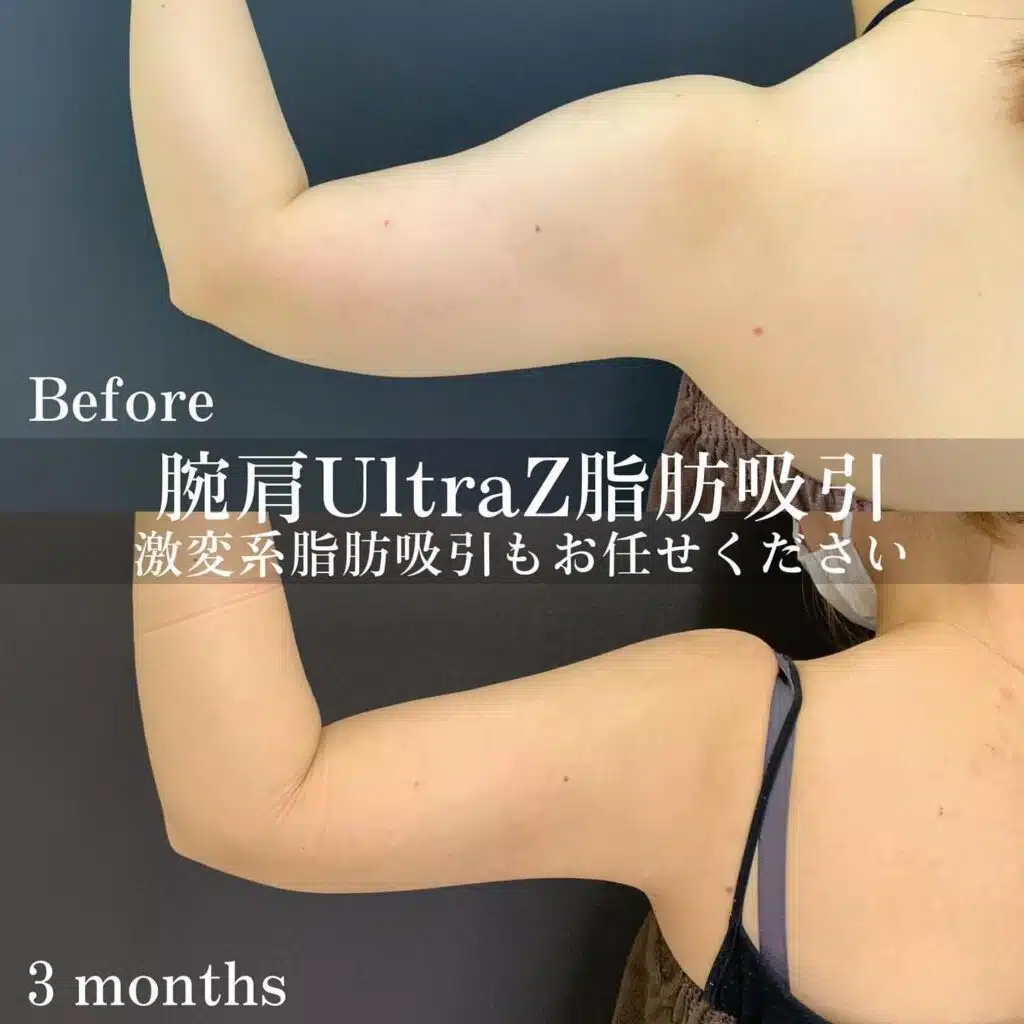 腕肩UltraZ脂肪吸引　東京　