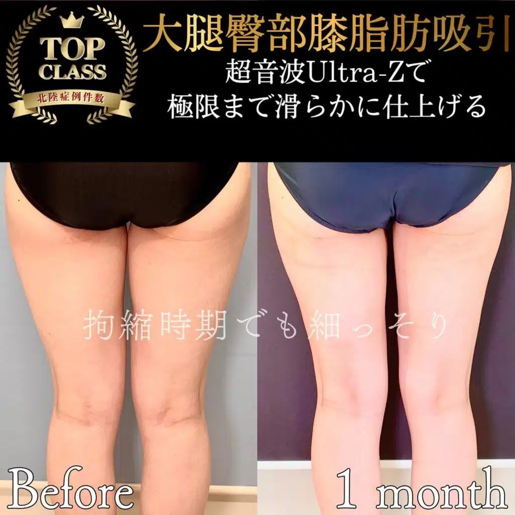 大腿臀部膝脂肪吸引　東京