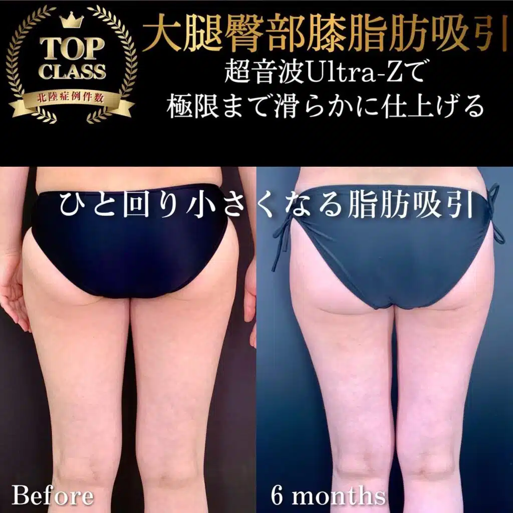 大腿臀部膝脂肪吸引　東京