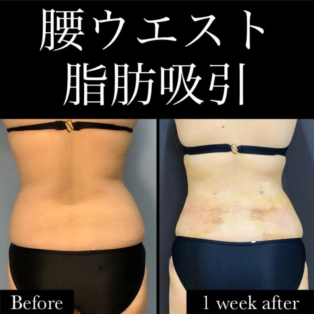腰ウエスト脂肪吸引　東京