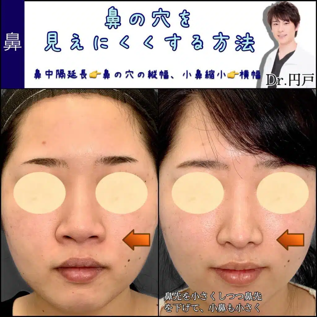 鼻中隔延長 小鼻縮小 東京