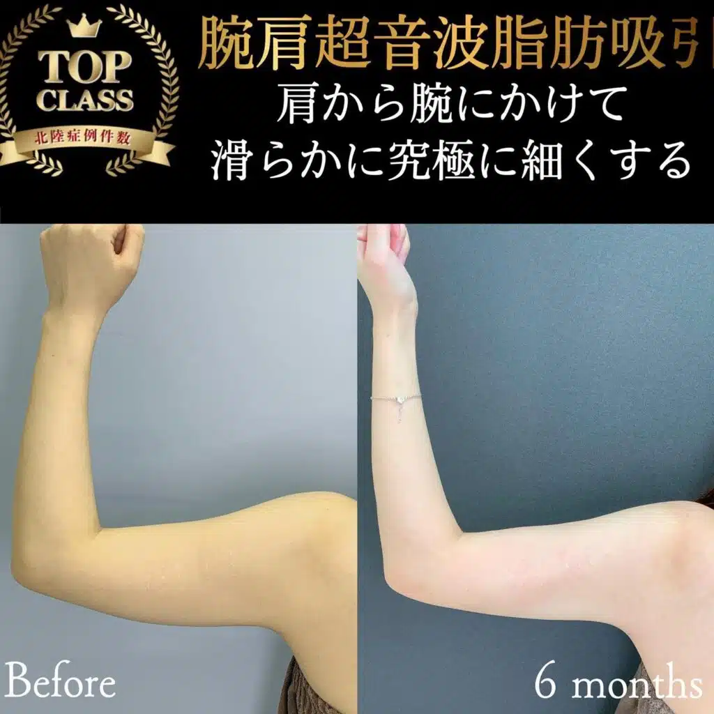 腕肩超音波脂肪吸引　東京