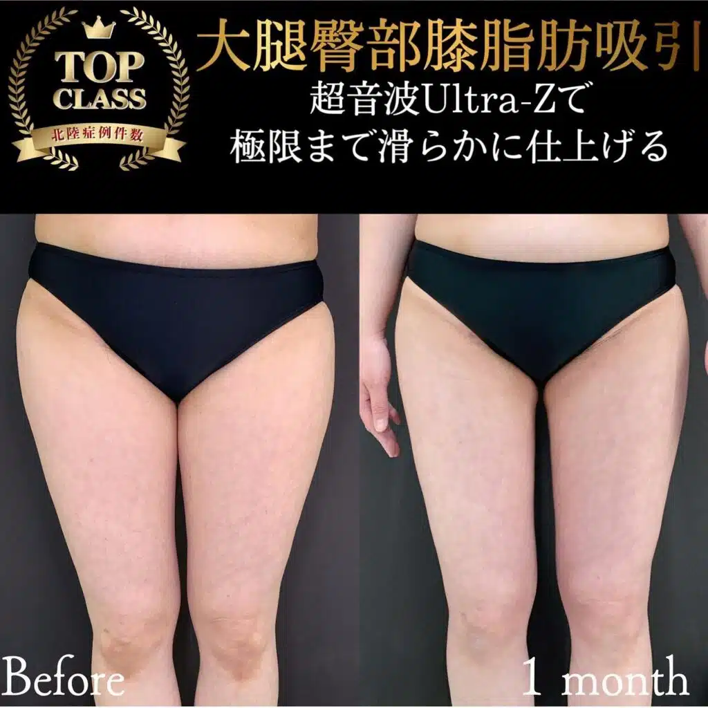 大腿臀部膝脂肪吸引　東京
