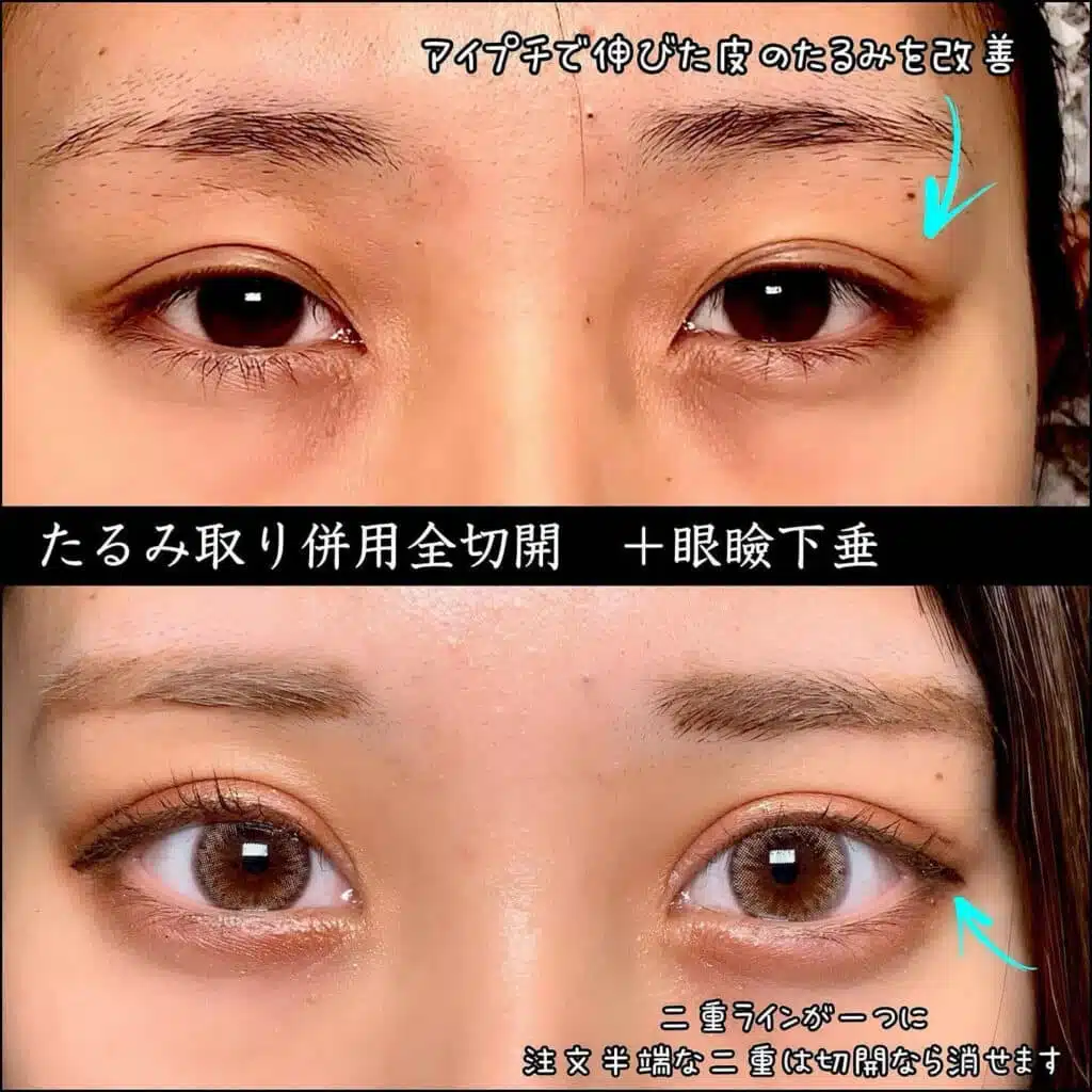 たるみ取り併用全切開+眼瞼下垂 東京