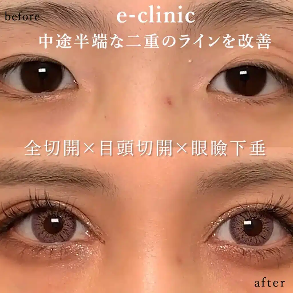 全切開×目頭切開×眼瞼下垂 東京