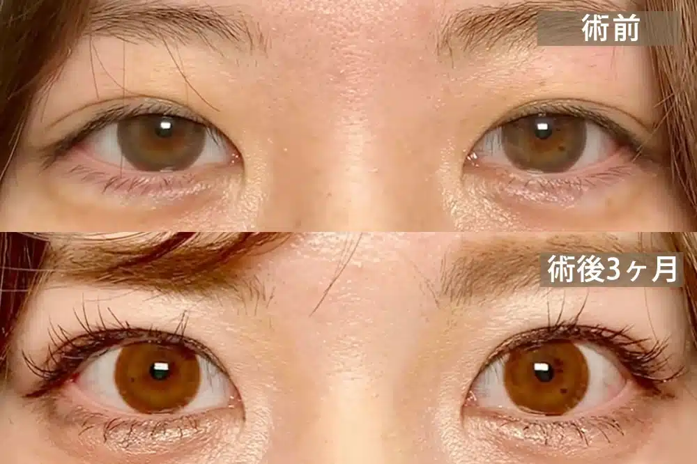 先天性眼瞼下垂 東京