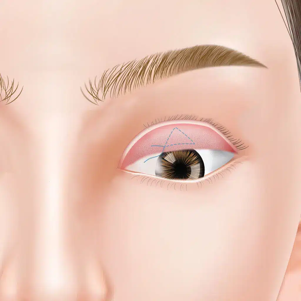 眼瞼下垂 手術方法 東京