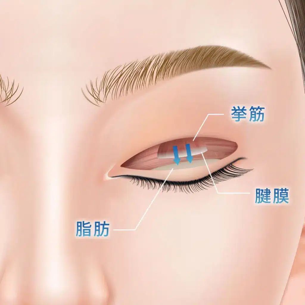 眼瞼下垂 手術方法 東京