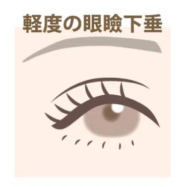 軽度の眼瞼下垂 東京