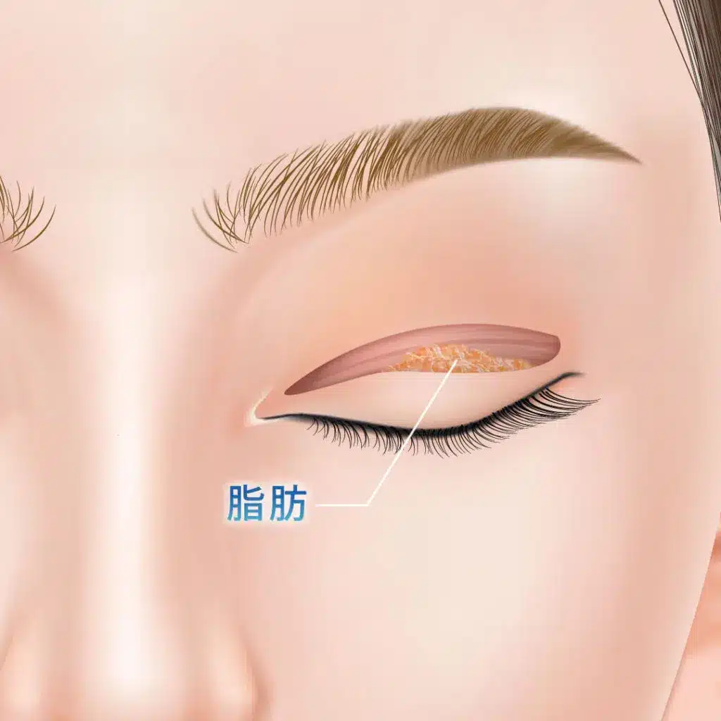 眼瞼下垂 手術方法 東京