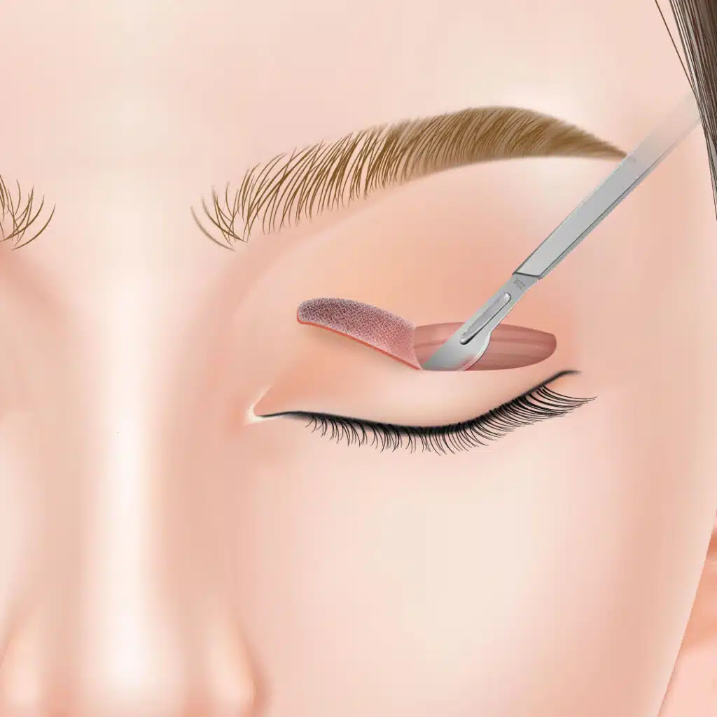 眼瞼下垂 手術方法 東京