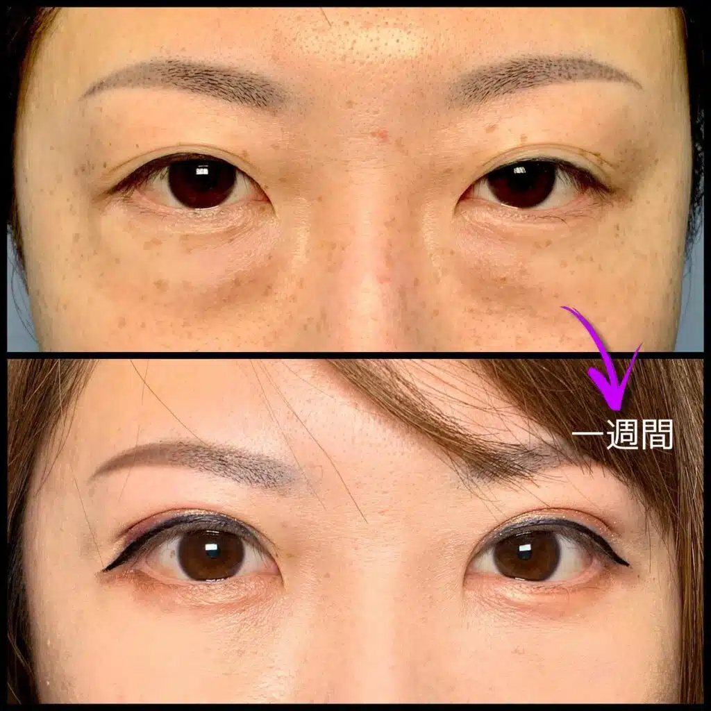 眼瞼下垂と全切開の傷跡の他院修正の1週間後の症例 東京