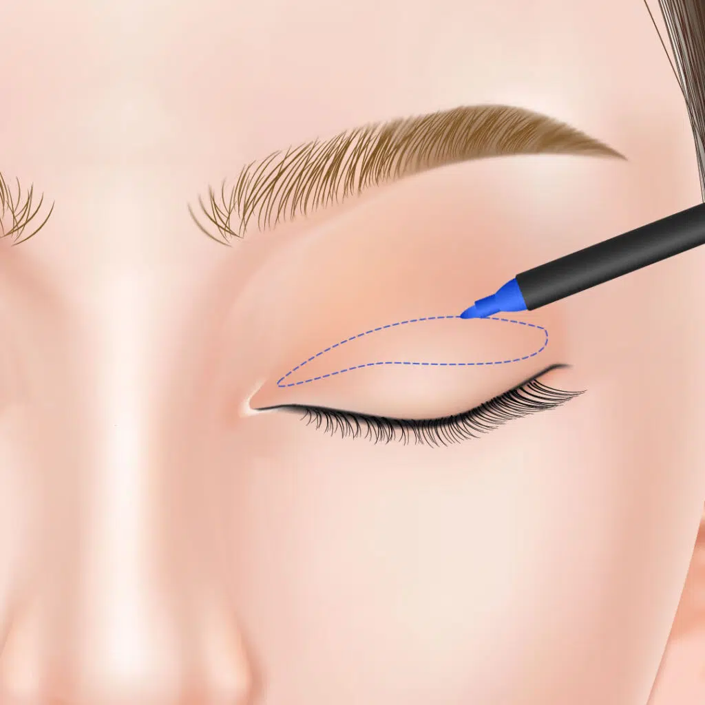 眼瞼下垂 手術方法 東京