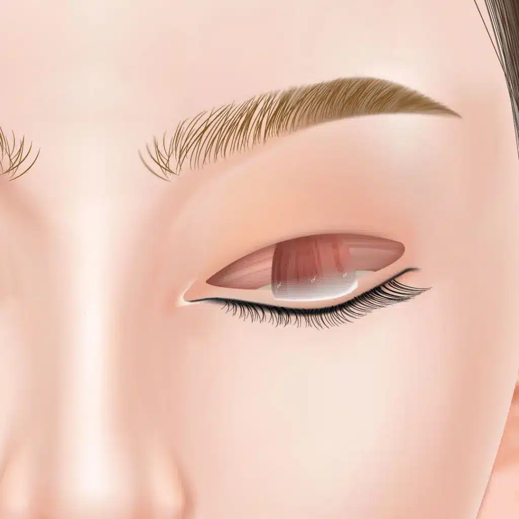 眼瞼下垂 手術方法 東京