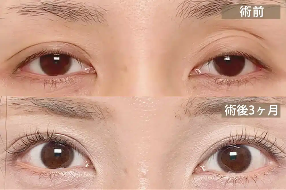 腱膜性眼瞼下垂(後天性眼瞼下垂) 東京